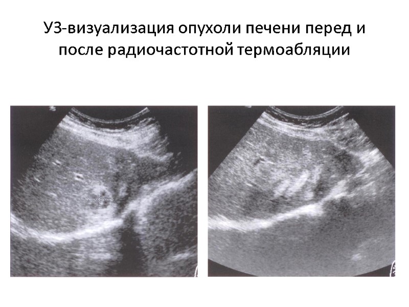 УЗ-визуализация опухоли печени перед и после радиочастотной термоабляции